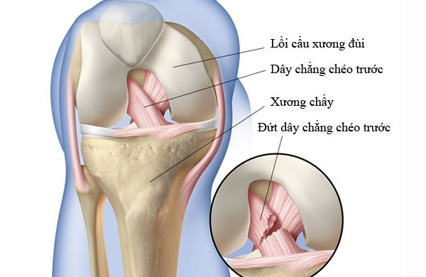 Top 5 bài tập vật lý trị liệu dây chằng chéo trước hiệu quả, an toàn 1 Đứt dây chằng chéo trước là gì?