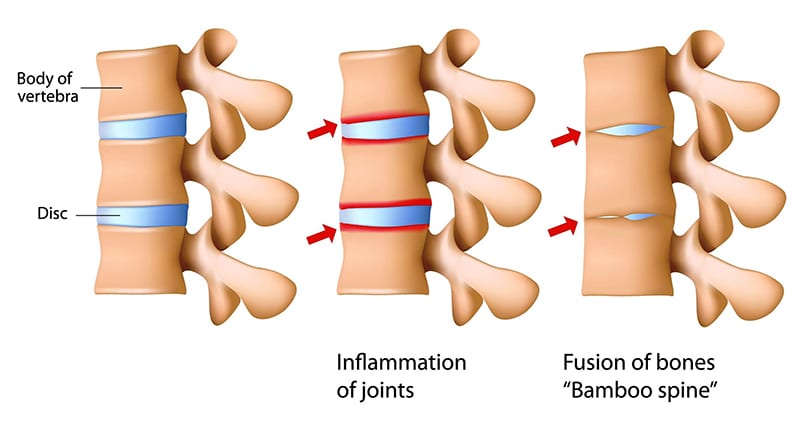 20201202_viem-cot-song-dinh-khop-co-nguy-hiem-khong-1 Viêm cột sống dính khớp có nguy hiểm không và các bài tập trị liệu