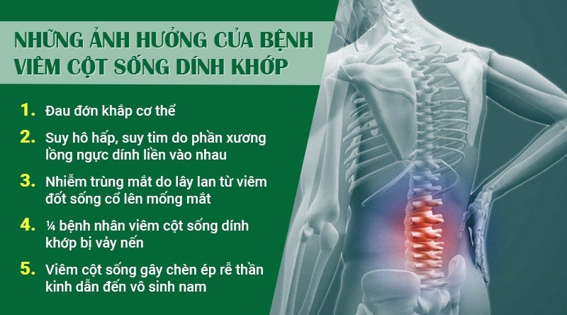 20201202_viem-cot-song-dinh-khop-co-nguy-hiem-khong-3 Viêm cột sống dính khớp có nguy hiểm không và các bài tập trị liệu