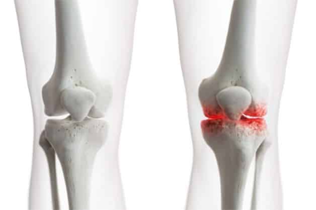 hien-tuong-thoai-hoa-khop-goi-o-nguoi-benh-1 thoái hóa khớp gối bệnh học và những điều cần chú ý