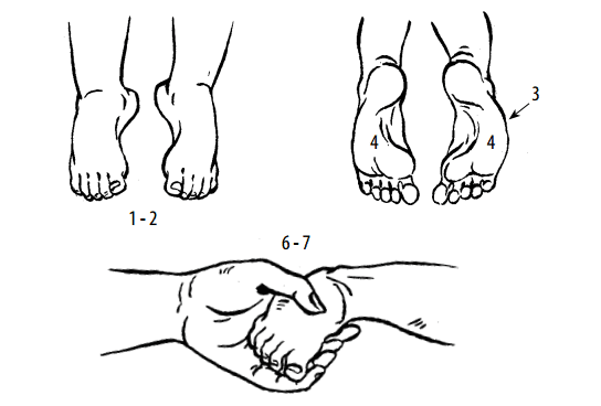 Phục hồi chức năng dựa vào cộng đồng: bàn chân khoèo bẩm sinh Phục hồi chức năng dựa vào cộng đồng: bàn chân khoèo bẩm sinh