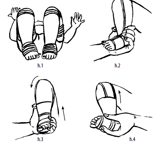 Phục hồi chức năng dựa vào cộng đồng: bàn chân khoèo bẩm sinh Phục hồi chức năng dựa vào cộng đồng: bàn chân khoèo bẩm sinh