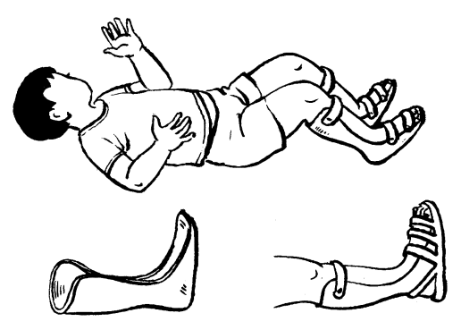 Phục hồi chức năng dựa vào cộng đồng: bàn chân khoèo bẩm sinh Phục hồi chức năng dựa vào cộng đồng: bàn chân khoèo bẩm sinh