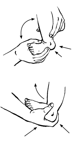 Phục hồi chức năng dựa vào cộng đồng: bàn chân khoèo bẩm sinh Phục hồi chức năng dựa vào cộng đồng: bàn chân khoèo bẩm sinh