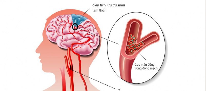 5 mẹo chữa rối loạn tiền đình không cần dùng thuốc hiệu quả 3 Bấm huyệt chữa rối loạn tiền đình