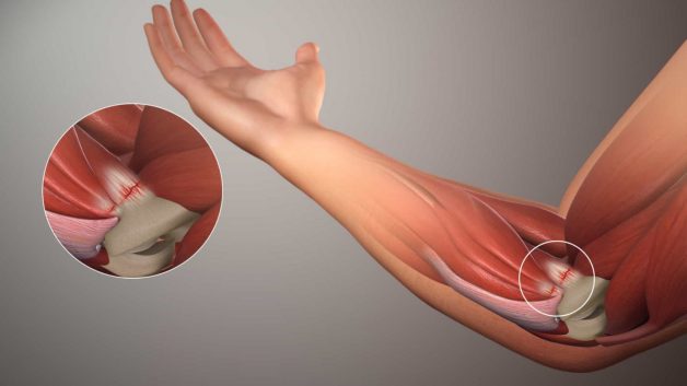 Hiểu về bản chất của bệnh lý đau khớp khuỷu tay