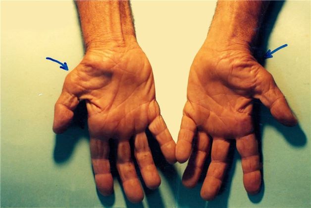 Nguyên nhân gây hội chứng đường hầm cổ tay