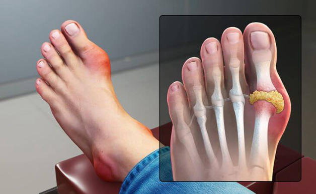 nhức ngón chân là bệnh gì