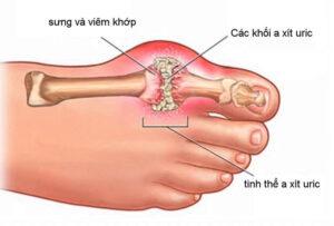 Tìm hiểu bệnh gout: Nguyên nhân, triệu chứng và cách điều trị 1 Bệnh Gout là gì?