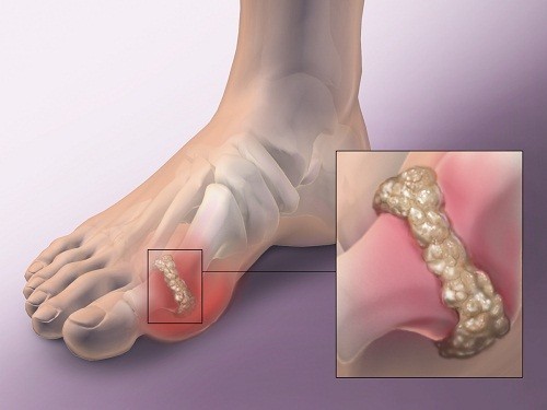 Bệnh gút thường ảnh hưởng đến các khớp ở phần dưới của cơ thể như đầu gối, mắt cá chân, hoặc ngón chân.