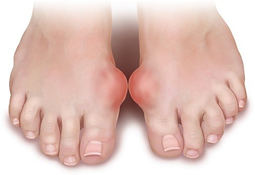 Khi tinh thể acid uric tích tụ trong khớp và các mô bao quanh tới một giới hạn nào đó, người bệnh sẽ có các triệu chứng như nóng, đau, sưng và rất mềm ở một số khớp nào đó, thường là ngón chân cái.