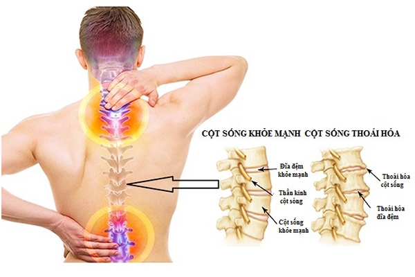 Bệnh lý thoái hóa cột sống: Nguyên nhân, cách điều trị và phòng ngừa 1 Bệnh lý thoái hóa cột sống là gì?