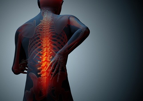 Đau lưng ở những người bị loãng xương, hoặc mật độ xương thấp, thường do gãy cột sống.