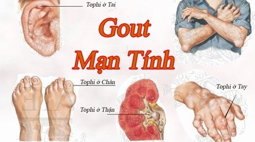 Đau xương khớp là triệu chứng cảnh báo bệnh gout