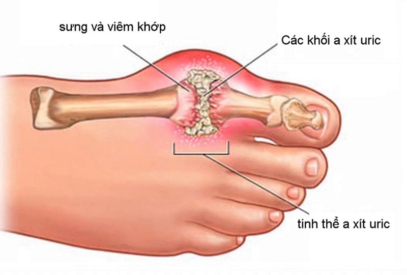 3 cách điều trị gout hiệu quả bạn nên biết 1 Bệnh Gout là gì?