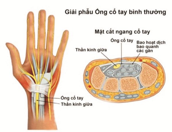 Hội chứng ống cổ tay là do dây thần kinh giữa bị chèn ép.