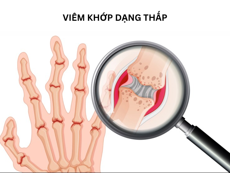 Cách điều trị viêm khớp dạng thấp an toàn, không biến chứng 3 Nguyên nhân gây viêm khớp dạng thấp