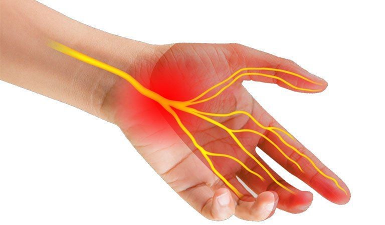 Hội chứng ống cổ tay: Nguyên nhân, triệu chứng và cách điều trị hiệu quả 1 Hội chứng ống cổ tay là gì?