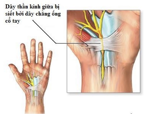 3 nguyên nhân gây tê tay về đêm và cách khắc phục hiệu quả 6 hoi chung ong co tay