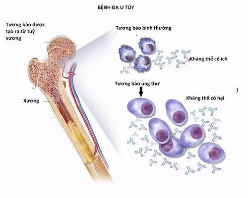 Đa u tủy xương xuất phát từ tương bào là thành phần của bạch cầu trong máu.