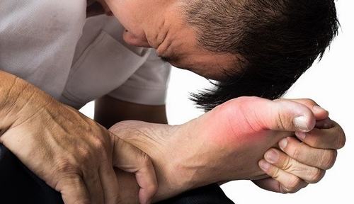 Triệu chứng thường gặp ở người mắc bệnh gút bao gồm: nóng, đau, sưng, và rất mềm ở 1 khớp, thường gặp nhất là ở 1 ngón chân cái.