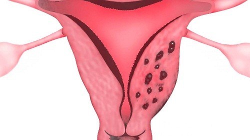 Lạc nội mạc trong cơ tử cung có thể gây đau vùng chậu mạn tính.
