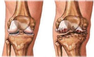 Điều trị u xương dạng xương hướng dẫn của chụp số hoá xoá nền 8 Điều trị viêm khớp nhiễm trùng