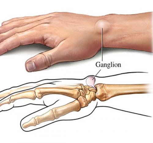 Nguyên nhân u bao hoạt dịch khớp cổ tay