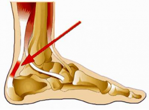 Viêm gân gót chân là tình trạng viêm điểm bám tận của gân gót chân gây ảnh hưởng lớn đến việc đi lại.