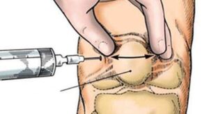 Điều trị thoái hóa khớp gối bằng tiêm chất nhờn 9 tiem chat nhon