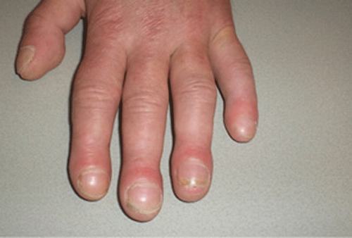 Khi bị ngón tay hình dùi trống, phần móng lồi hơn mức bình thường tùy theo từng giai đoạn.