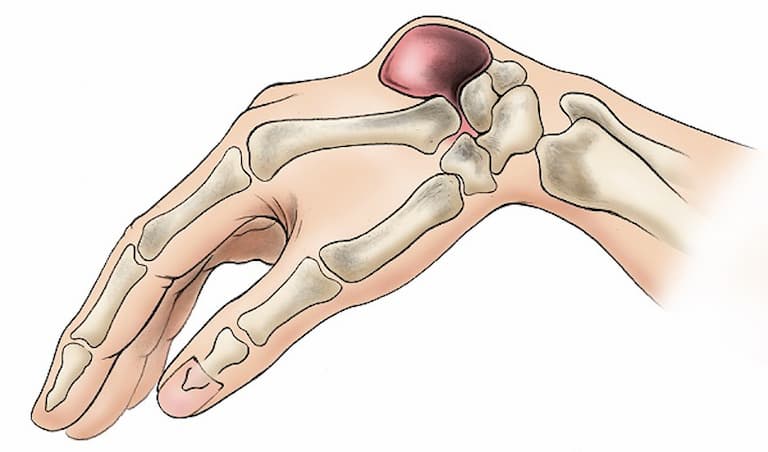Viêm bao hoạt dịch khớp: Nguyên nhân, triệu chứng và cách điều trị 2 Viêm bao hoạt dịch xuất hiện cơn đau khi vận động hoặc chạm nhẹ vào vùng viêm.