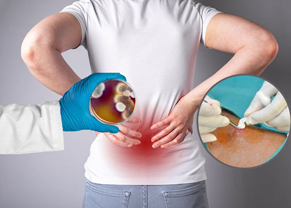 Viêm cơ, áp xe cơ: Nguyên nhân, triệu chứng và biện pháp phòng ngừa 1 Viêm cơ và áp xe cơ là gì?