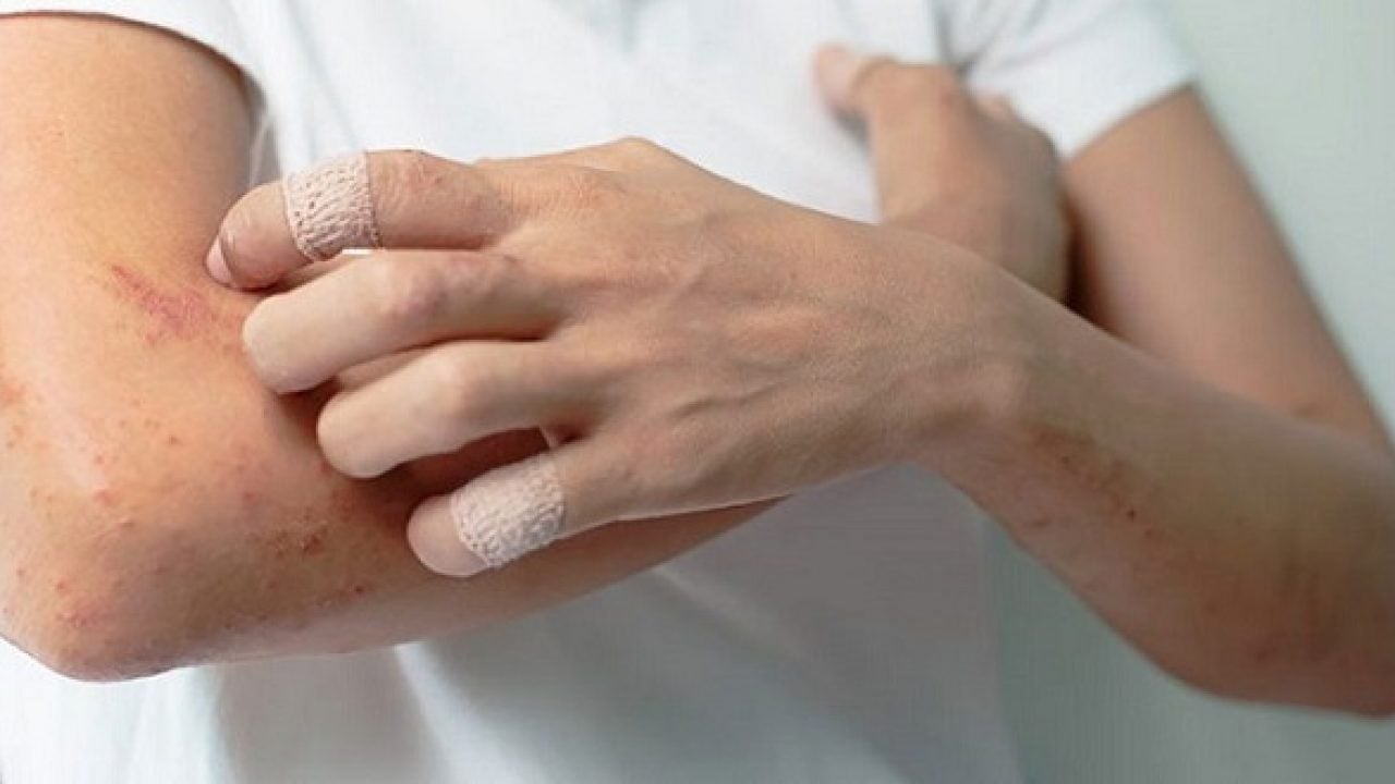 Viêm cơ, áp xe cơ: Nguyên nhân, triệu chứng và biện pháp phòng ngừa 3 Triệu chứng viêm cơ, áp xe cơ