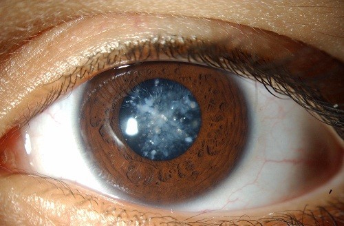 Đục thủy tinh thể có thể phát triển từ tình trạng viêm kéo dài ở mắt.