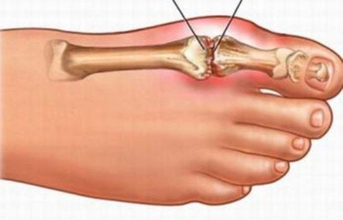 Các bệnh xương khớp thường gặp ở ngón chân cái 1 Viêm khớp ngón chân cái