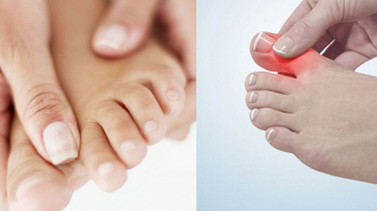 Các bệnh xương khớp thường gặp ở ngón chân cái 2 Nguyên nhân gây đau khớp ngón chân cái