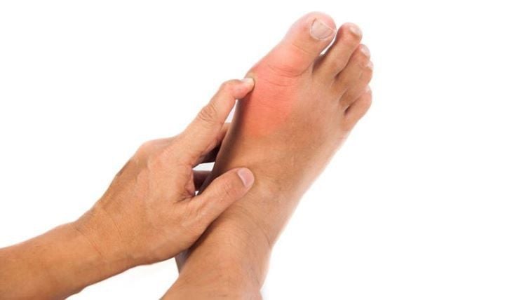 Các bệnh xương khớp thường gặp ở ngón chân cái 3 Triệu chứng viêm khớp ngón chân cái